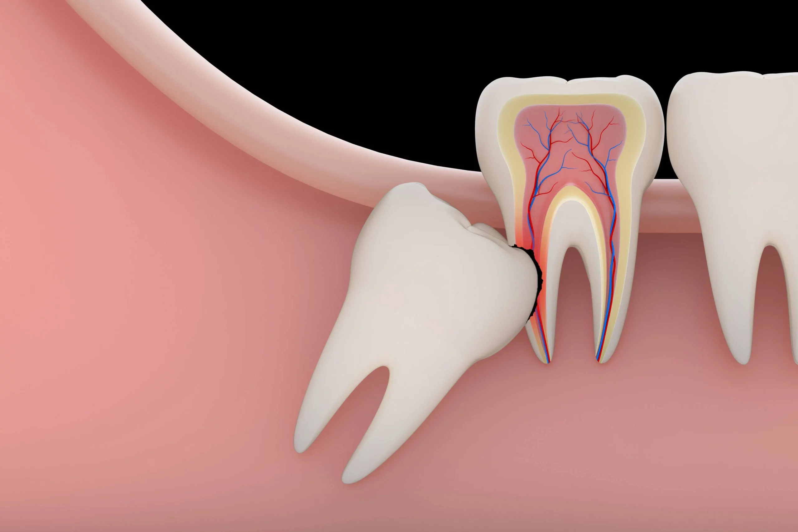 Удаление ретенированного зуба