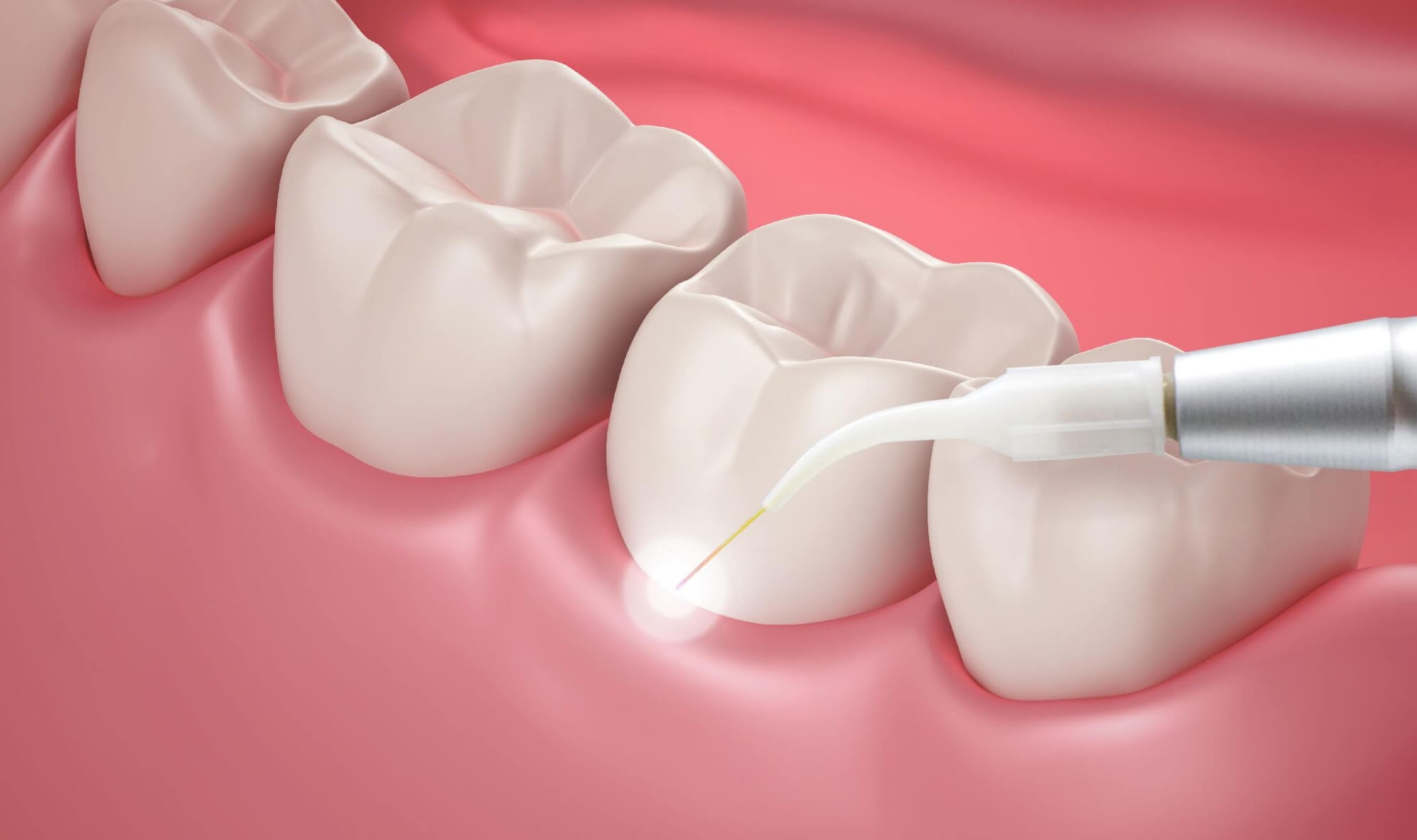 Снятие зубных отложений скейлером (1 зуб)